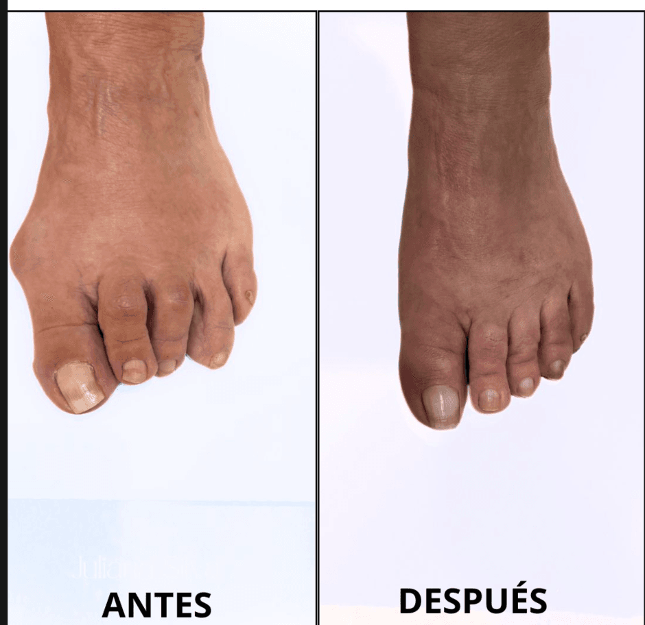 Antes - Corrección Hallux Valgus Severo
