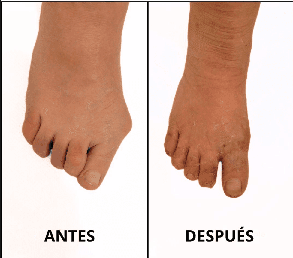 Después - Cirugía Estética del Pie