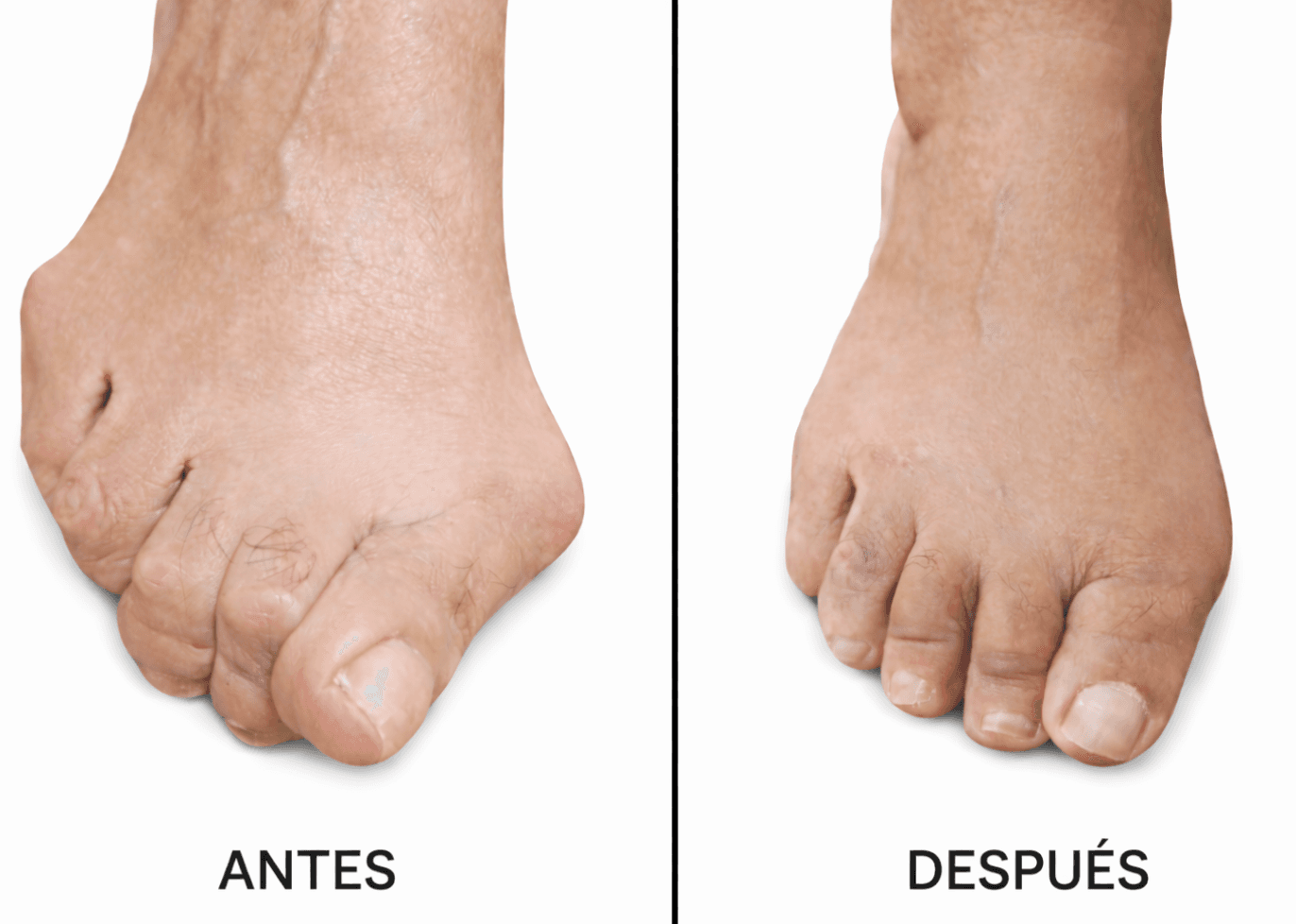 Antes/Después - Dedos en Garra